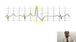 Mastering ECGLesson17 PVCs amp PACs  premature ventricular amp atrial contractions [upl. by Eynobe]