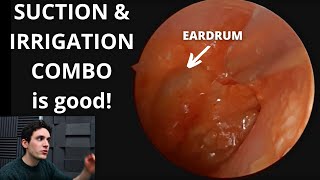 Suction And Irrigation Ear Wax Removal Is it good [upl. by Darrelle112]