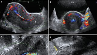 Cervicitis on ultrasound Dilated cervix [upl. by Culhert]