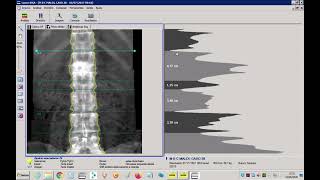 Demonstração de análise de exames de densitometria óssea utilizando software Encore GELunar [upl. by Mart]