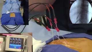 Radiofrequency Ablation Explanation Video Demonstration  LIVE [upl. by Datha]