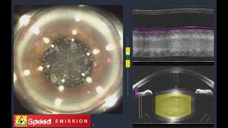 Femtosecond laser cataract surgery – Professor Gerard Sutton [upl. by Mulderig]