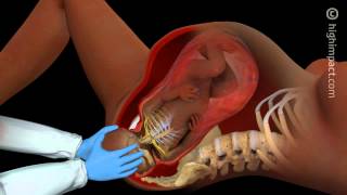 Brachial Plexus Injury [upl. by Alya]