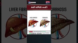 How Dangerous Is Liver Cirrhosis l Dr DVL Narayana Rao shorts MedPlusONETV [upl. by Erida]