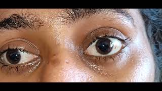 Complete Bilateral Ophthalmoplegia Video [upl. by Ruthy835]