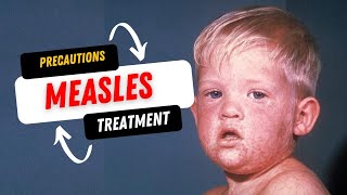 Measles symptoms precaution and Treatment [upl. by Neirda]