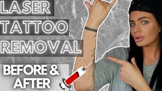 LASER TATTOO REMOVAL EXPERIENCE 💉 Before amp After  FAQs [upl. by Vizzone722]