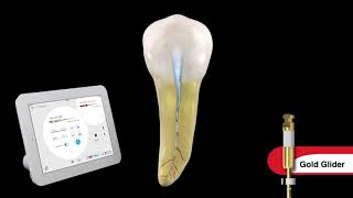 Endodontic Canal Preparation with Dr Ruddle [upl. by Harberd665]