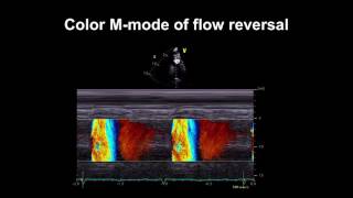 Echocardiography Essentials Detecting aortic regurgitation [upl. by Smallman131]