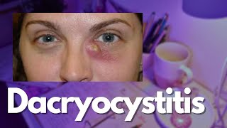 Dacryocystitis  Ophthalmology Notes [upl. by Kcirddahc740]