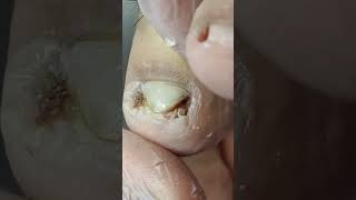 Ep60 Ingrown Toenail Removal Improper trimming of ingrown toenails can lead [upl. by Nolubez]