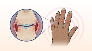 What Is Rheumatoid Arthritis  NEJM [upl. by Eelyahs398]