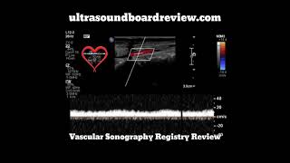 Tardus Parvus Spectral Doppler [upl. by Kciredorb]