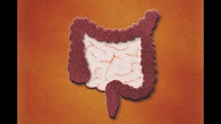 Patología Isquémica Intestinal Definición Evaluación Tratamiento [upl. by Pincas]