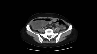 Colon adenocarcinoma [upl. by Sax615]