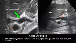 Bile Duct Ultrasound Reporting  CBD amp Hepatic Duct Pathologies amp Diseases  How To Write USG Report [upl. by Virgy276]