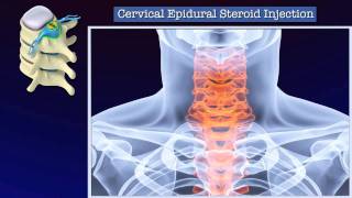 CERVICAL STEROID INJECTIONS [upl. by Eednam]