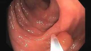 Colonoscopy Video Tour Removal of a Colon Polyp Polypectomy [upl. by Doscher]