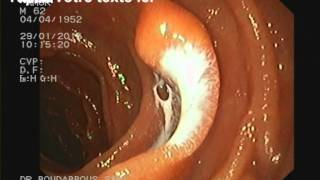 lactocele duodenal [upl. by Noramac]