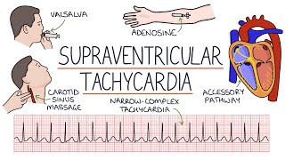 Understanding Supraventricular Tachycardia SVT [upl. by Fonda]