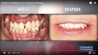 Dientes inmediatos con implantes dentales [upl. by Adila]