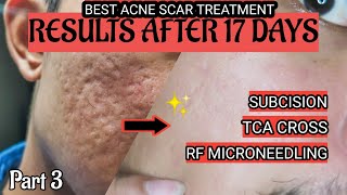 PART 3  RESULTS BEFORE AND AFTER ACNE SCAR TREATMENT [upl. by Aisatsanna]