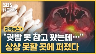 quot귓밥 못 참고 팠는데…quot 상상 못할 곳에 퍼졌다 자막뉴스  SBS [upl. by Anihsak]