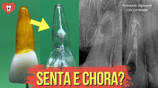 ENDODONTIA EM REABSORÇÃO INTERNA  PASSO A PASSO  Endolovers [upl. by Sitra]