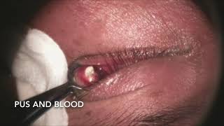 Incision and Drainage of Chalazion [upl. by Gosnell]