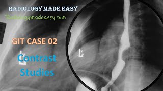 FRCR Radiology  A 60 year old patient presented with progressive dysphagia  GIT Contrast Study 02 [upl. by Yruok]