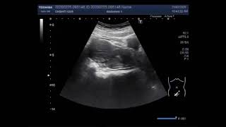 Ultrasound Video showing Cervicitis with dilated cervix uteri [upl. by Sillad]