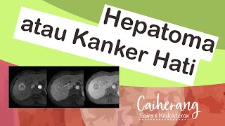 Mengenal Kanker Hati atau Hepatocellular Carcinoma HCC  Deteksi dan Pengobatan Kanker Hati [upl. by Slade352]