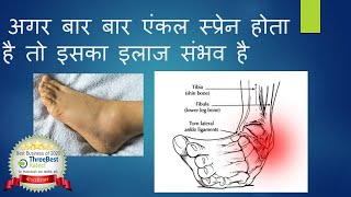 Chronic Ankle Pain and instability is Treatable Hindi टखने में मोच।टखने का दर्द का इलाज संभव है [upl. by Dnaltroc]