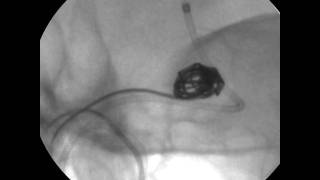 Use of the MicroAngiographic Fluoroscope for Coiling of Intracranial Aneurysms Video 2 [upl. by Colston]