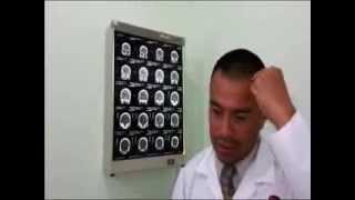 Hematoma Subdural Cerebral Tratamiento neurologia segura [upl. by Yazbak]