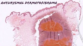 Aneurysmal dermatofibroma dermatofibroma with internal hemorrhage pathology dermpath dermatology [upl. by Auhsej959]