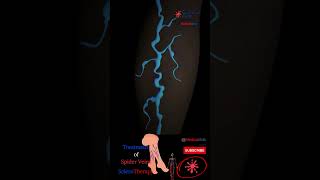 Spider Veins Treatment  ScleroTherapy  Legs Varicose Injection shorts [upl. by Ttoille]