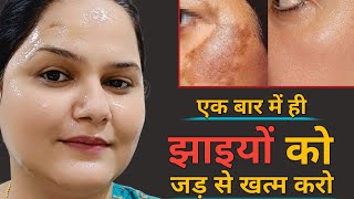 कितनी भी पुरानी झाइयांPigmentation जड़ से खत्म करो  How to Remove Pigmentation 100 Resultjhaiya [upl. by Reeher49]