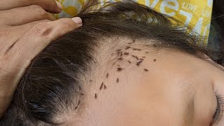 Head lice removing from brown hair  How to clear out all head lice [upl. by Auot]