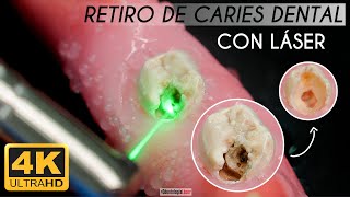 INCREIBLE 😮  Caries Dental EXTERMINADA con LÁSER en 4k 🦷  Odontología Láser [upl. by Ieppet784]