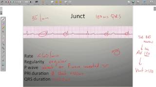 ECG Junctional Rhythms [upl. by Naoj]