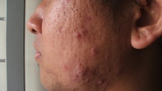 What Is Cystic Acne  Acne Treatment [upl. by Hsiekal]