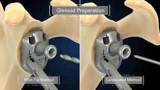 Equinoxe Ergo Instruments for Reverse Shoulder [upl. by Ecniv]