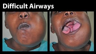 VividTrac  Nasal Intubation Difficult Airway [upl. by Yager]