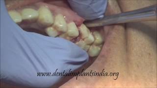 How to use luxator and forceps to remove upper decayed first molar [upl. by Huxley]