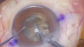 Salzmann corneal degeneration removed during phaco for a dense cataract [upl. by Azilanna]