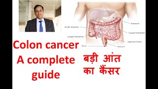 Colon cancer in Hindi Large Bowel large intestine cancer Symptoms treatment Dr Vikas Singla [upl. by Horgan]