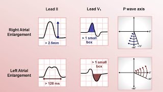 Intro to EKG Interpretation  Chamber Enlargement [upl. by Tannie]