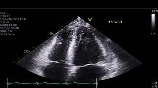 Reverse Stress Cardiomyopathy [upl. by Amikehs644]