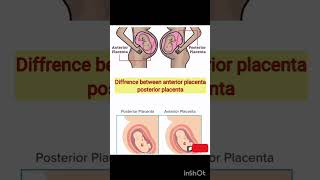 Difference between anterior placenta posterior placenta  anterior  posterior [upl. by Ormand]